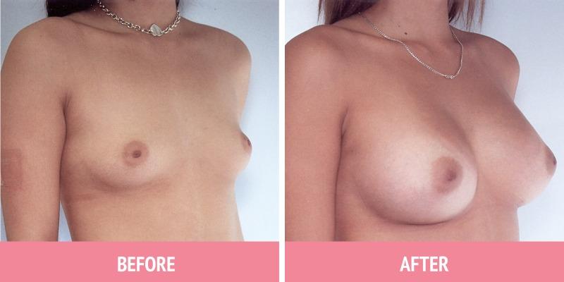 Breast Augmentation Sydney