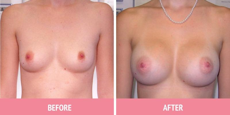 Breast Augmentation Sydney