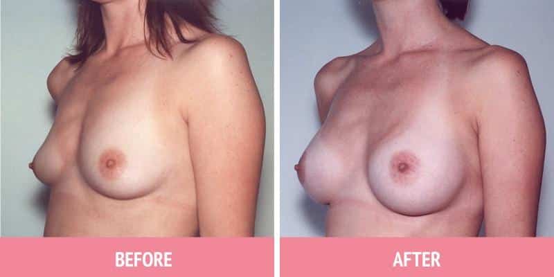 Breast Augmentation Sydney