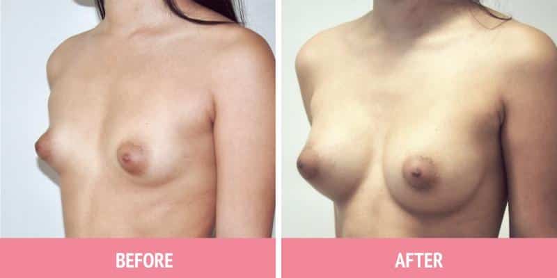 Breast Augmentation Sydney