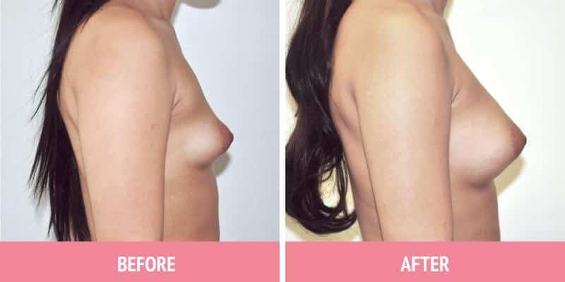 Breast Augmentation Sydney