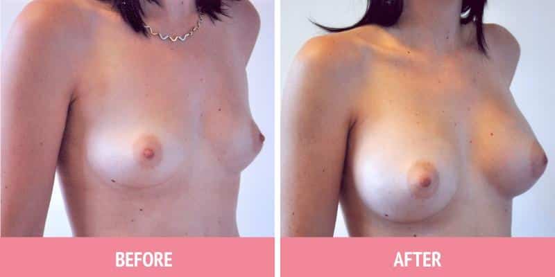 Breast Augmentation Sydney