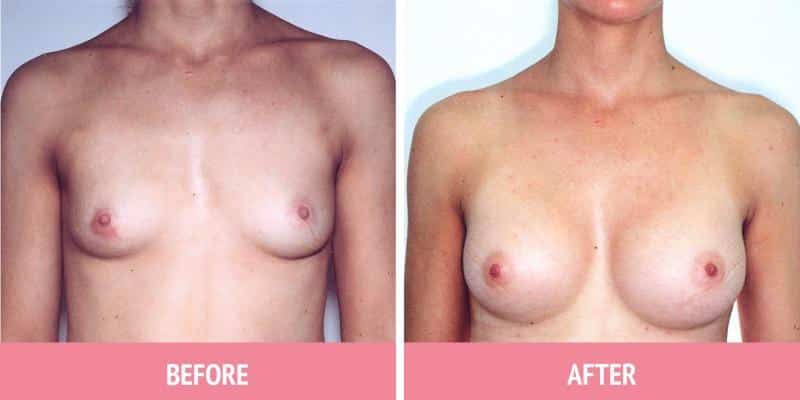 Breast Augmentation Sydney