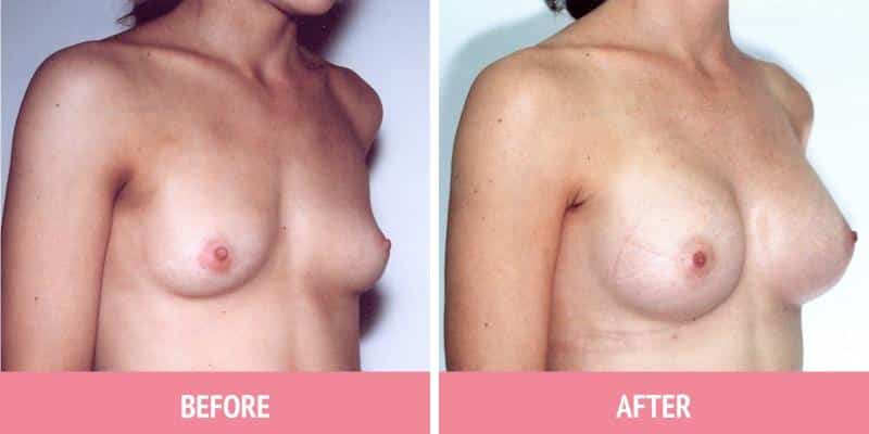 Breast Augmentation Sydney