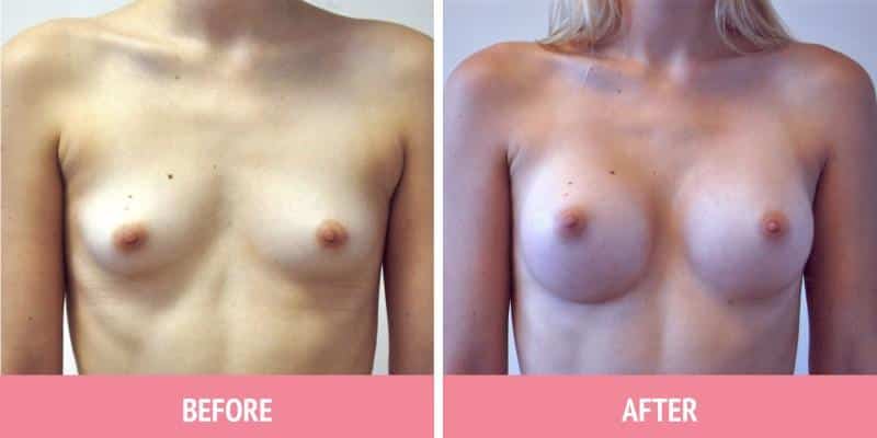 Breast Augmentation Sydney