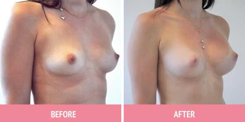 Breast Augmentation Sydney