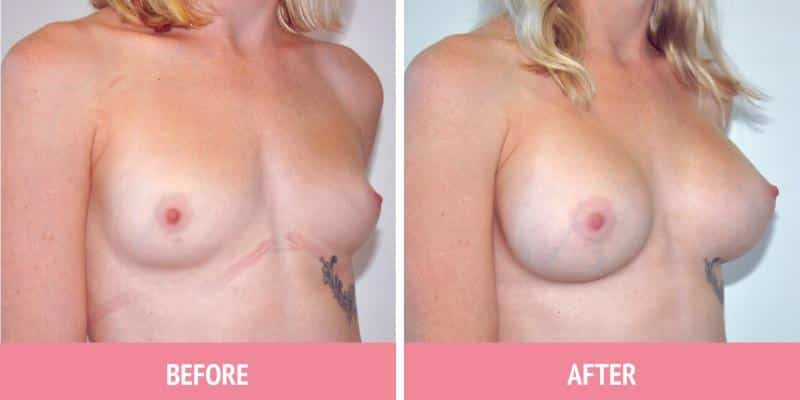 Breast Augmentation Sydney