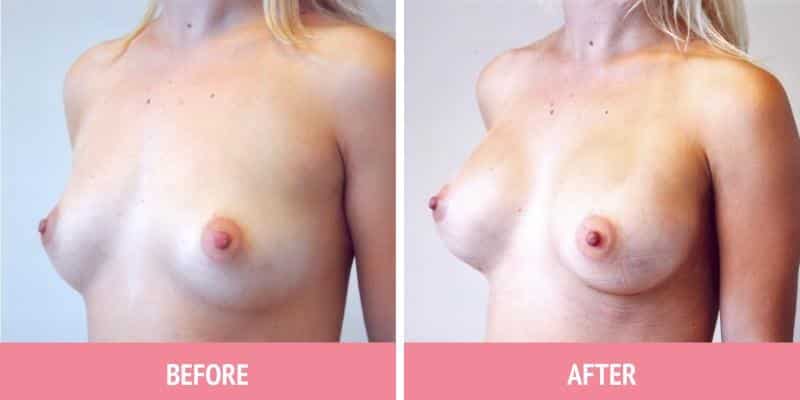 Breast Augmentation Sydney