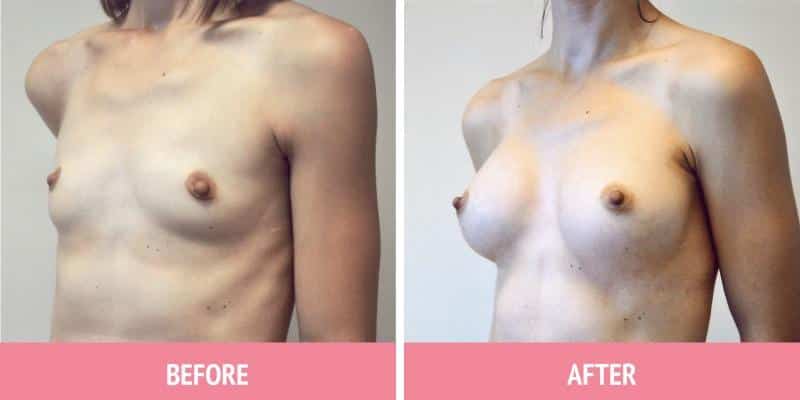 Breast Augmentation Sydney