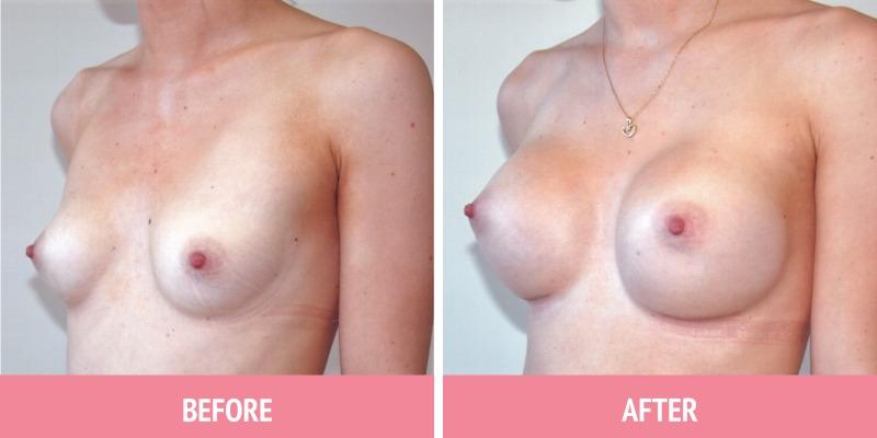 Breast Augmentation Sydney