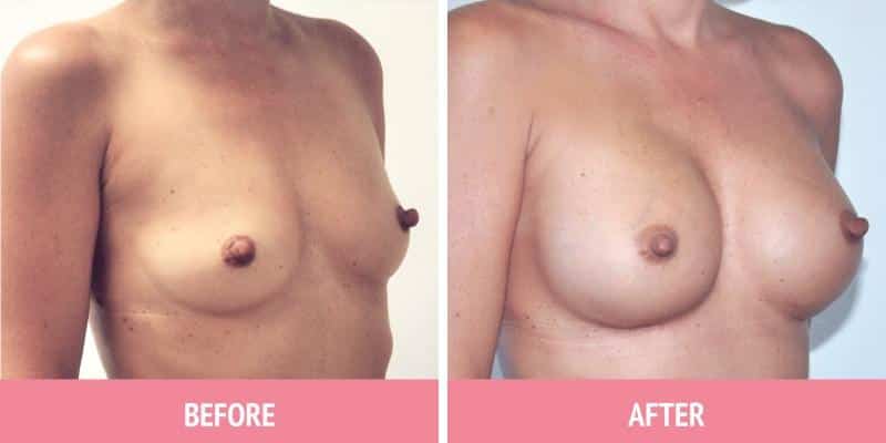 Breast Augmentation Sydney