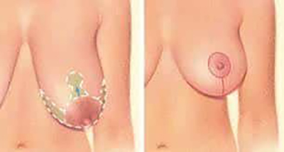 Breast Lift Before and After