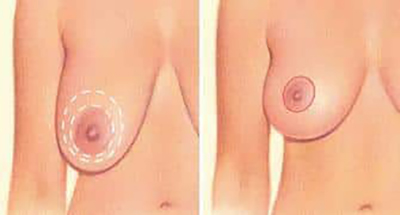 Breast Lift Before and After