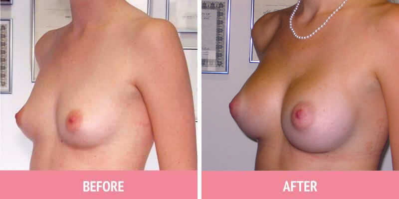 Best Breast Augmentation Sydney