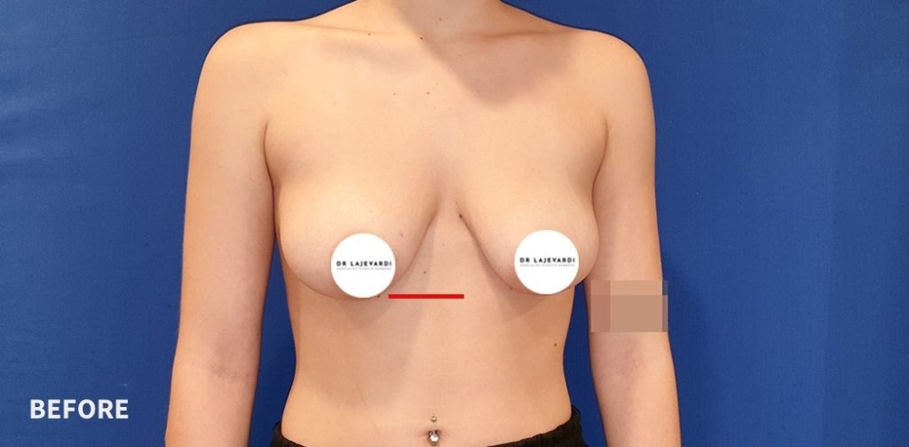 Breast Lift Before and After