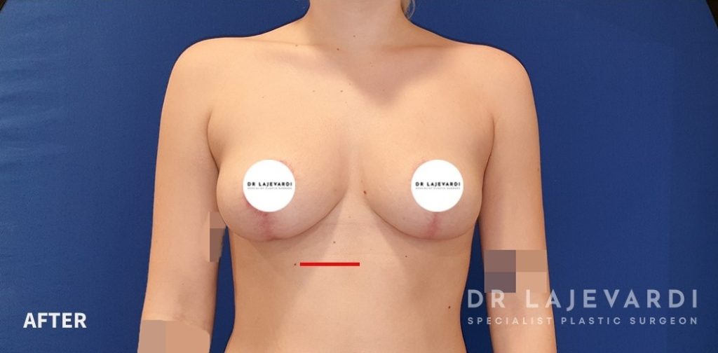 Breast Lift Before and After