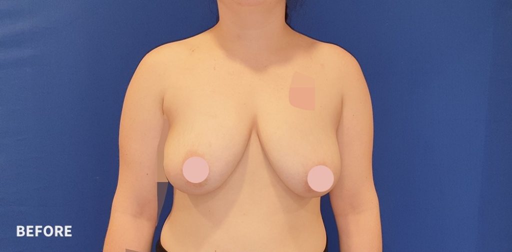 Breast Lift Before and After