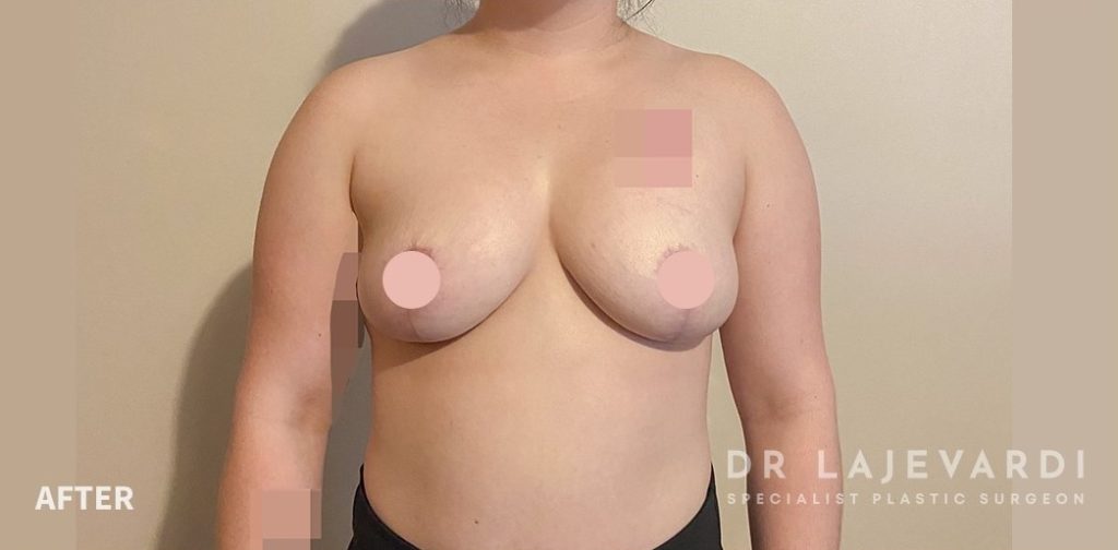 Breast Lift Before and After