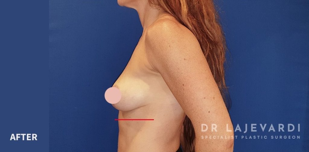 Breast Lift Before and After