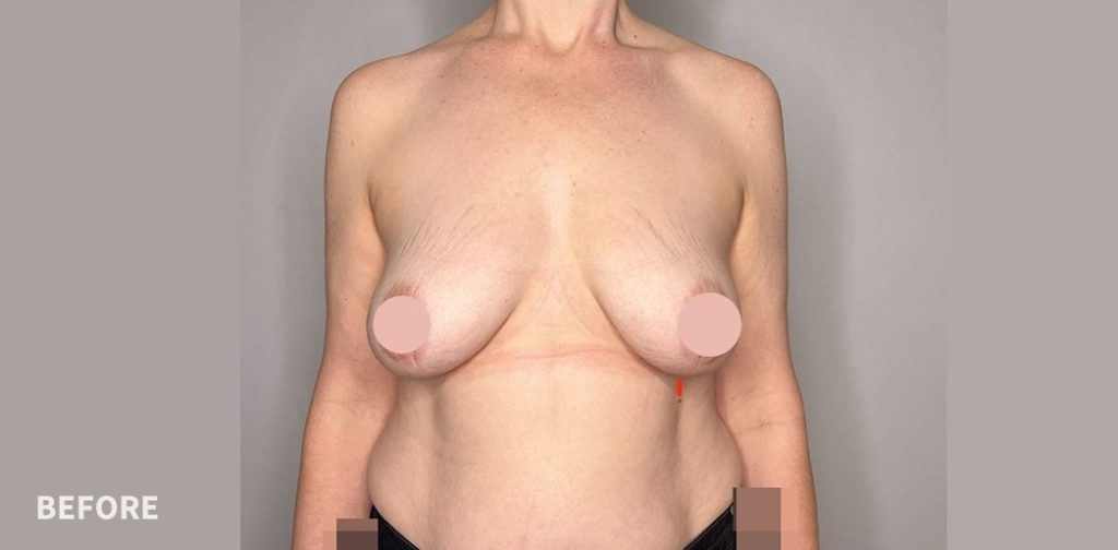 Breast Lift Before and after