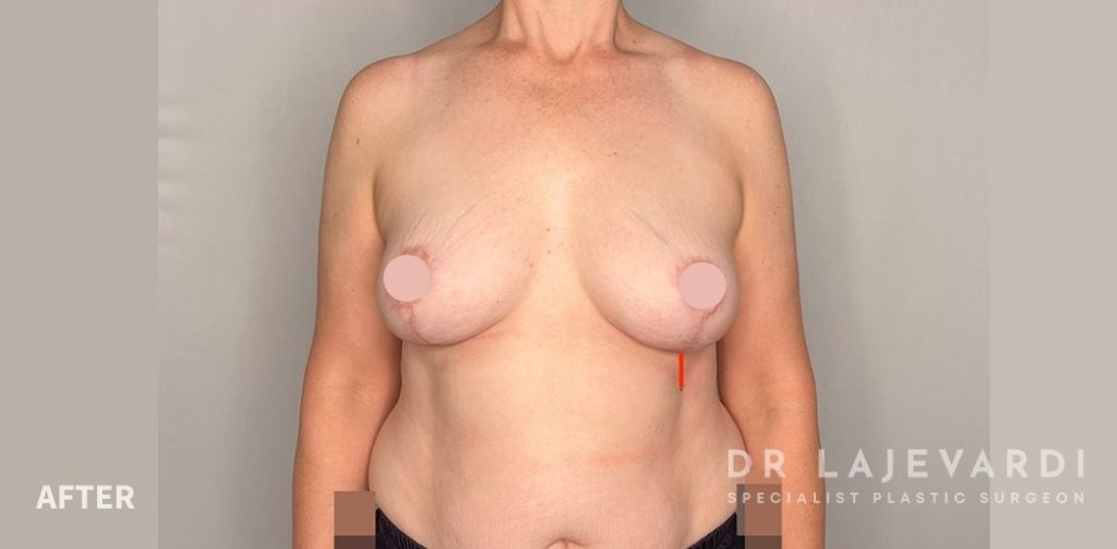 Breast Lift Before and After