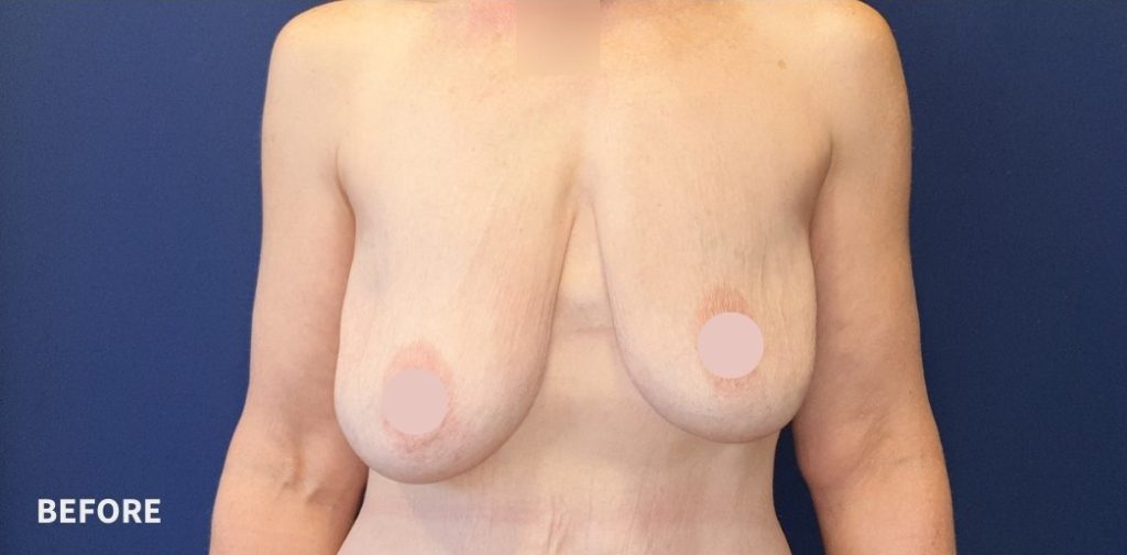 Breast Lift Before and After