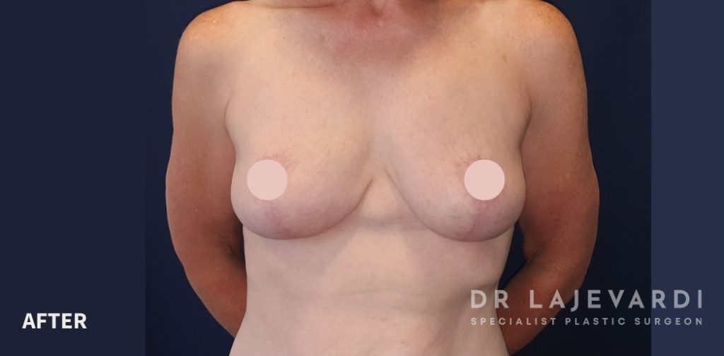 Breast Lift Before and After