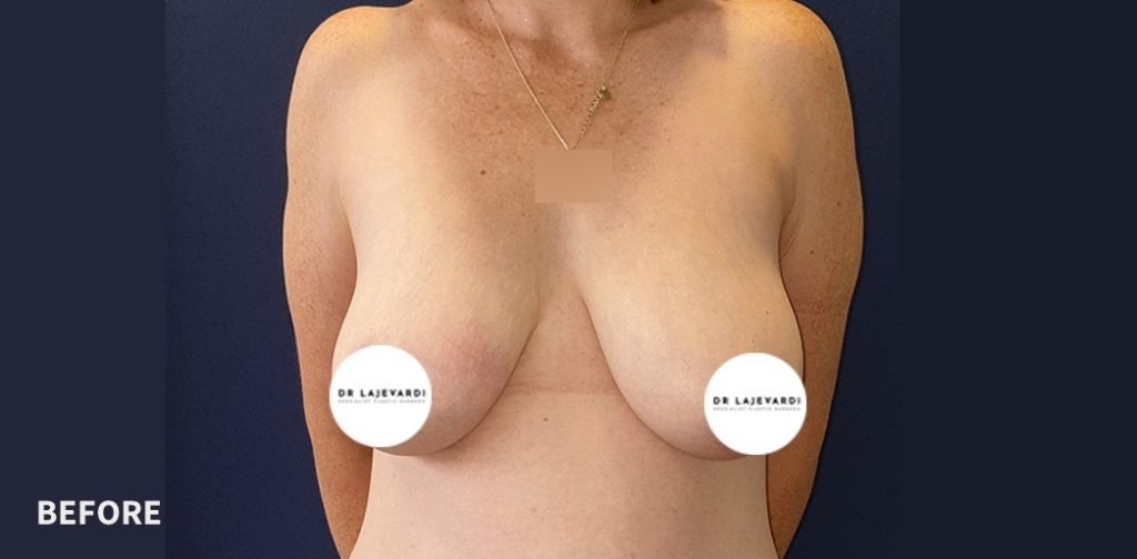 Breast Lift Cost Australia