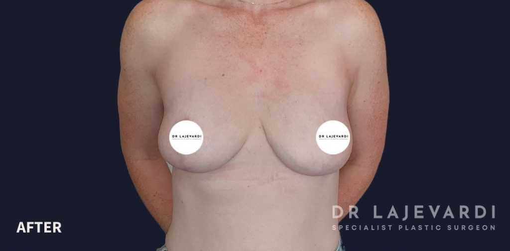 Breast Lift Cost Australia