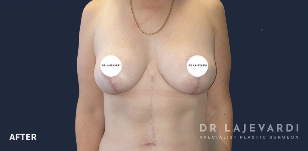 Breast Lift Sydney