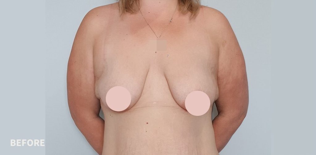 Breast Lift Sydney