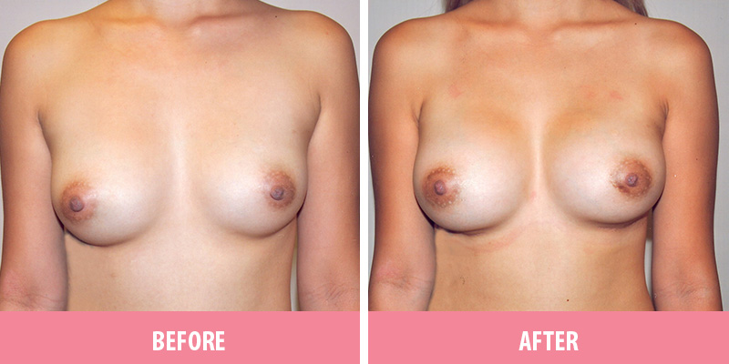 Breast Augmentation Surgery Sydney