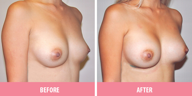 Breast Augmentation Sydney