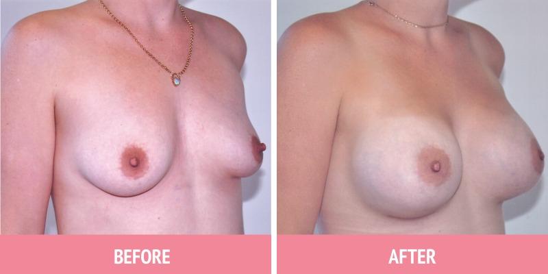 Breast Augmentation Sydney