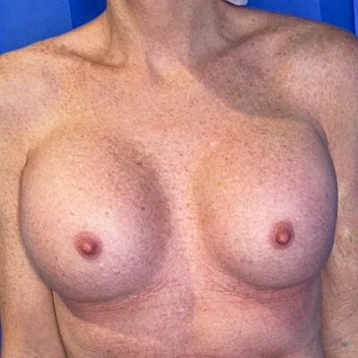 before-implant-revision-surgery-image