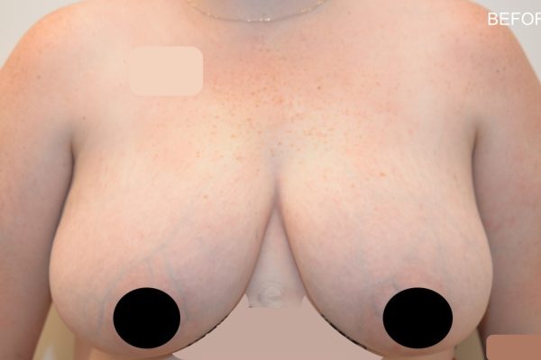 Pat 1 - Breast Reduction Before