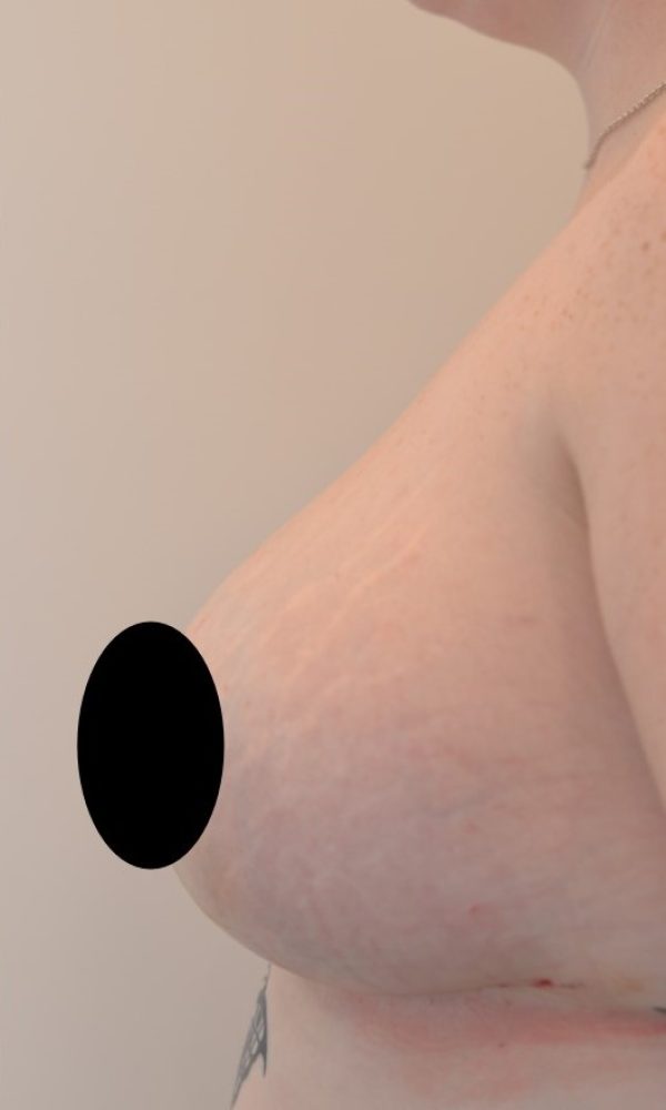 Patient 1 - Breast Reduction, L. After