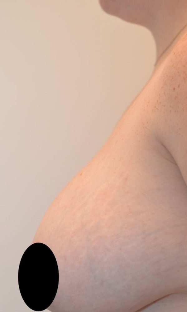 Patient 1 - Breast Reduction, L. Before