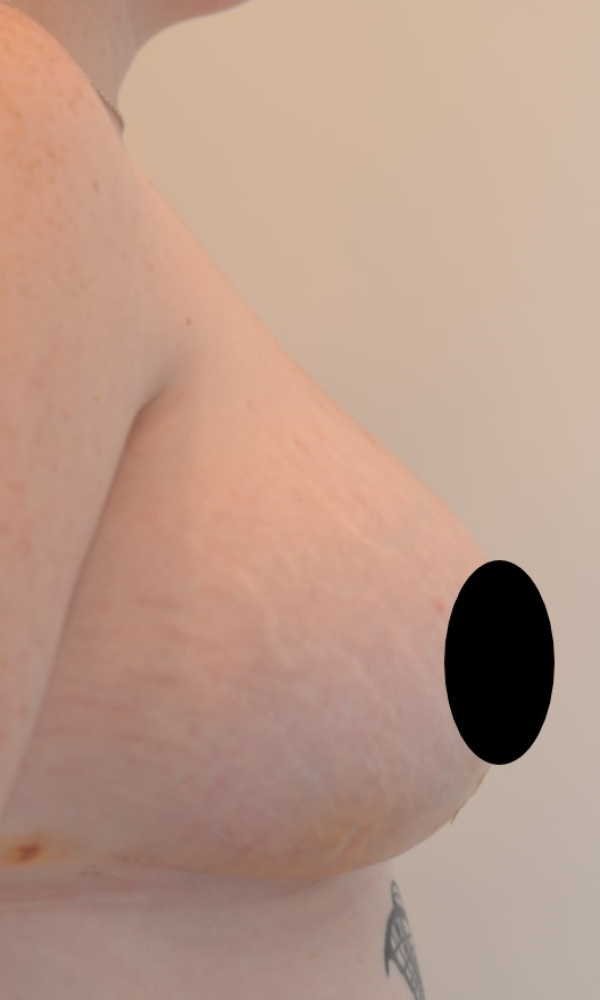 Patient 1- Breast Reduction, R. After.jpg