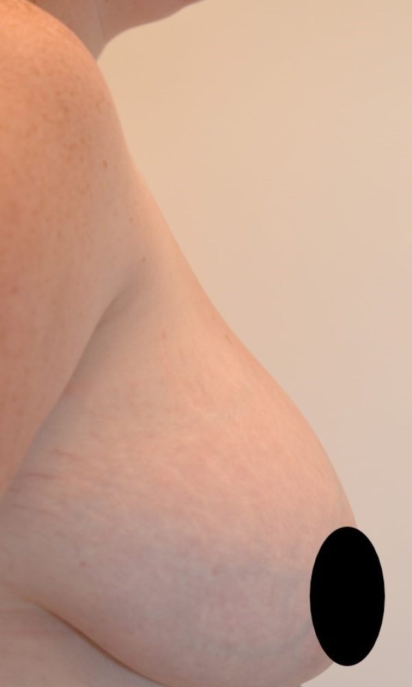 Patient 1- Breast Reduction, R. Before