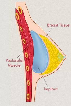 Breast Implant Position