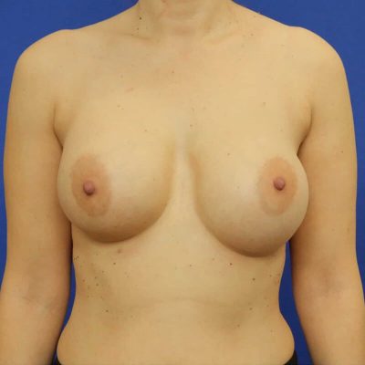 Breast Implant Revision Surgery