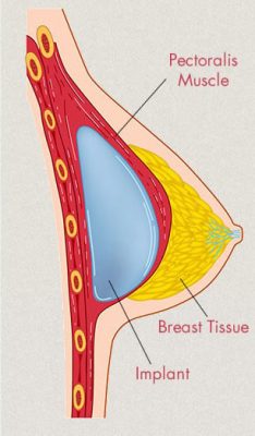 Breast Implants Sydney Australia