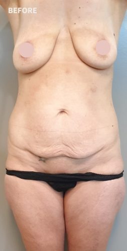 Breast Lift Cost Australia