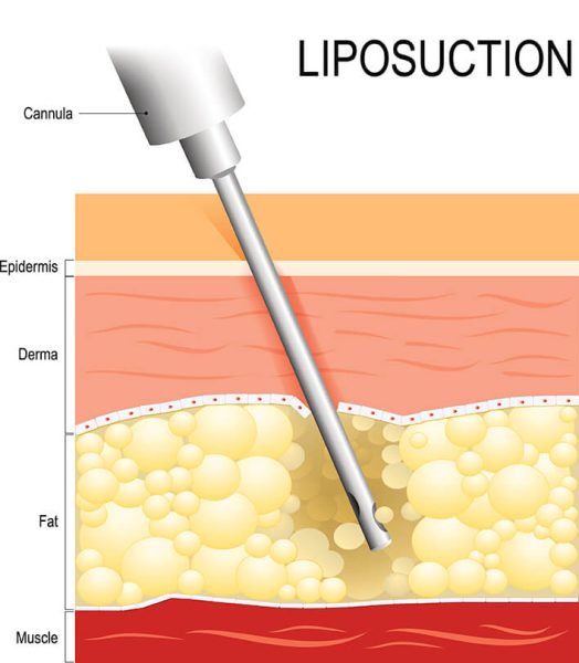 Fat Transfer Breast Augmentation Sydney