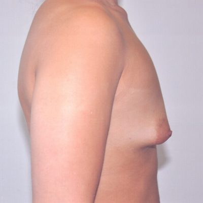 Tuberous Breast Augmentation