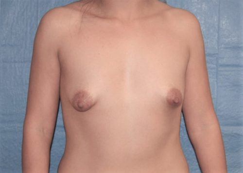 Tuberous Breast Correction